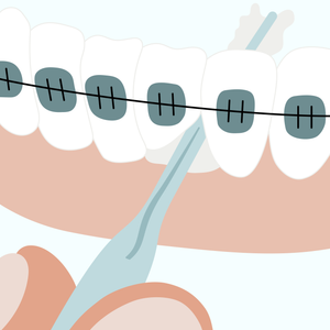 Illustration of teeth with braces using a FLIX stick to remove plaque from in between two teeth.